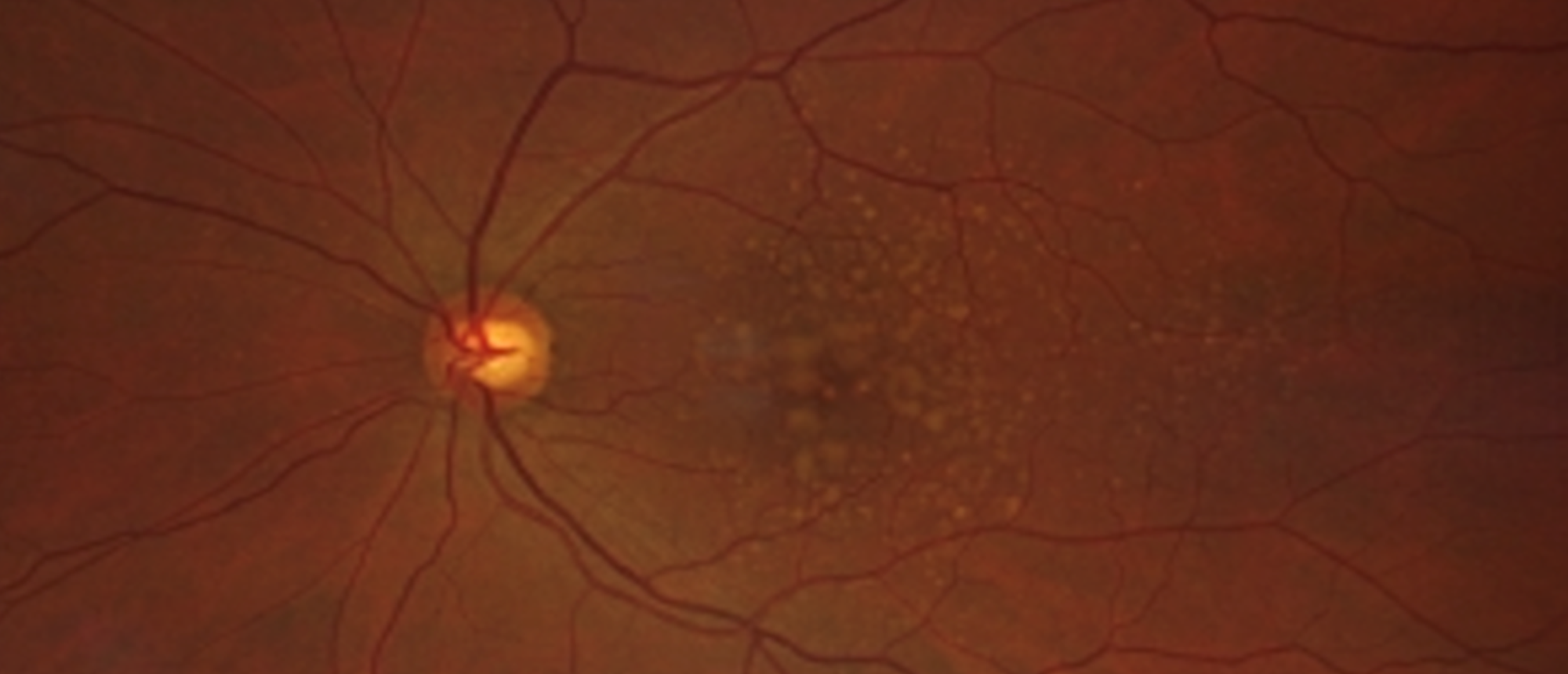 Exudative Non-Neovascular Age Related Macular Degeneration