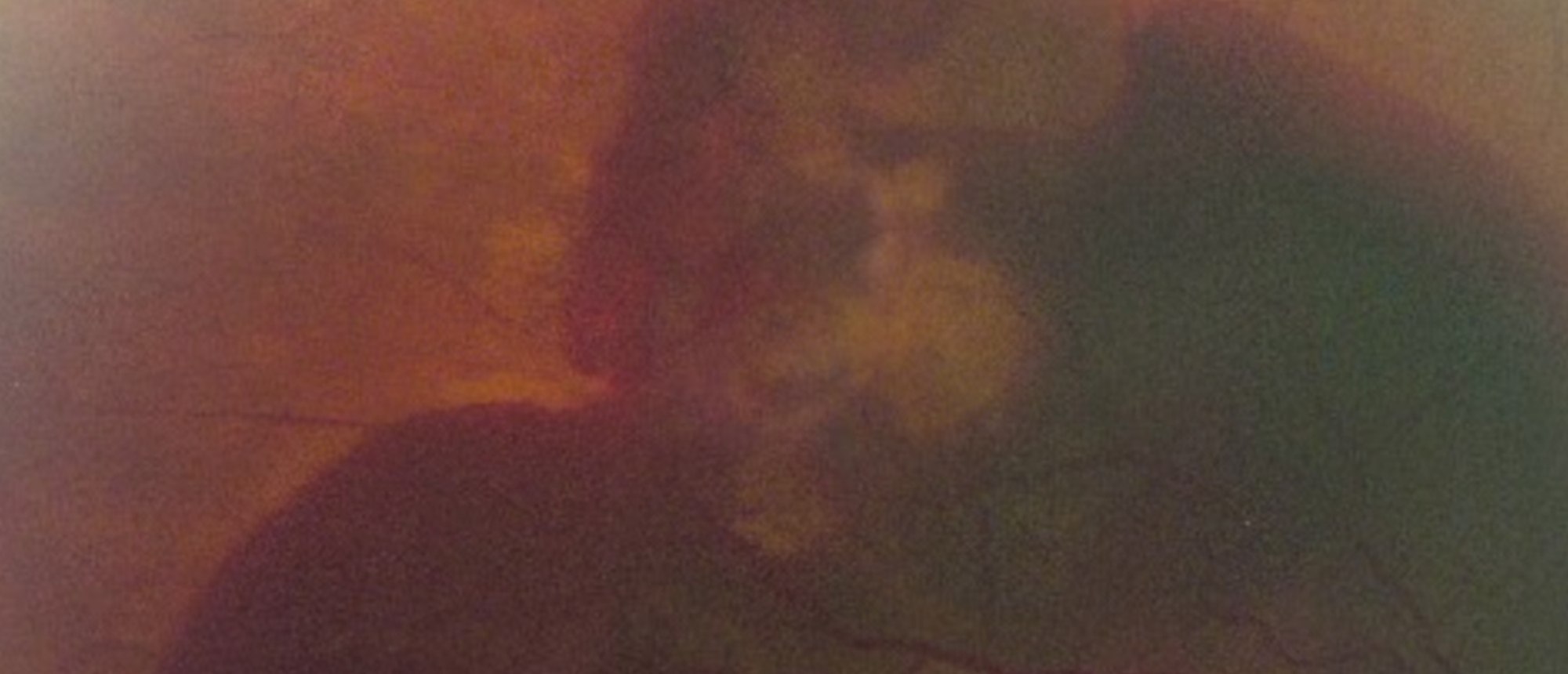 PEHCR (Peripheral Exudative Hemorrhagic Chorioretinopathy)