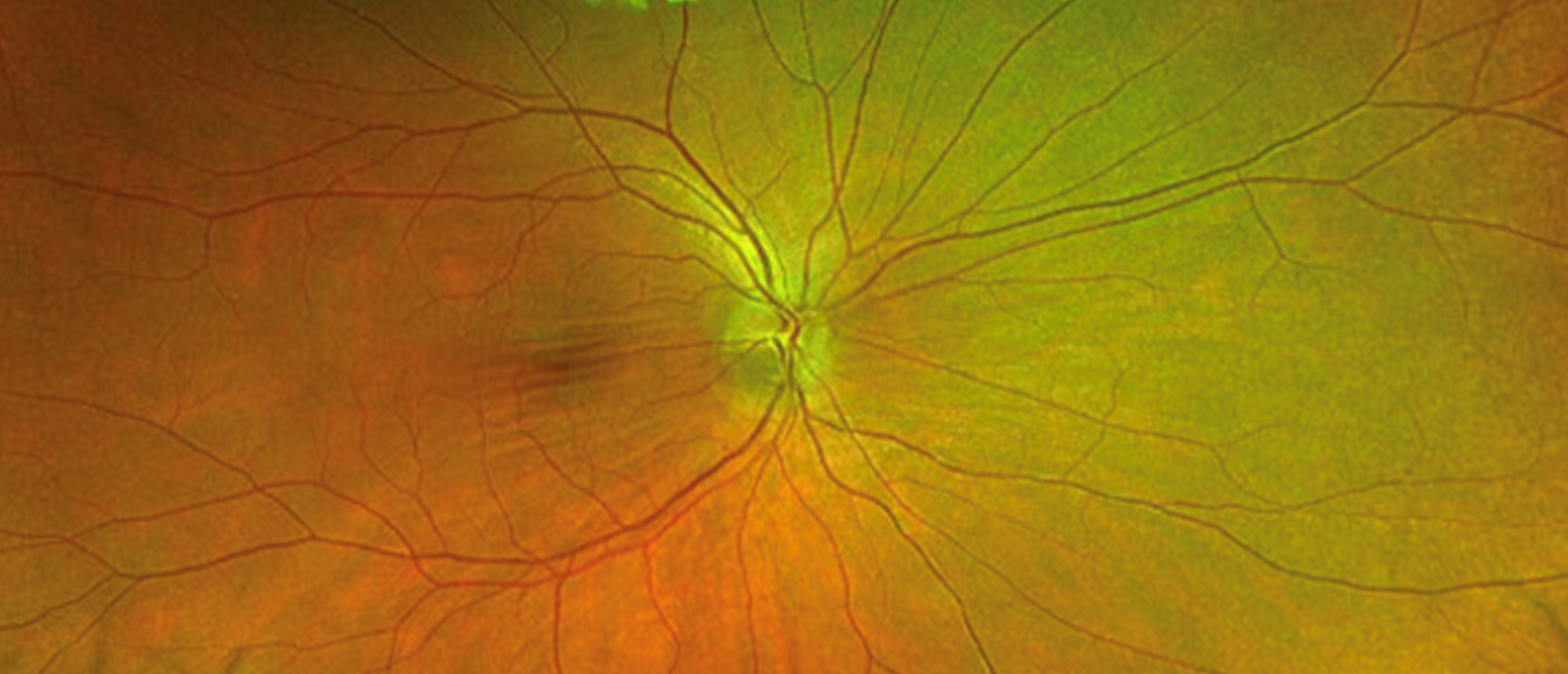 Suspected Adult-Onset Asthma with Periocular Xanthogranuloma vs. Erdheim-Chester Disease 
