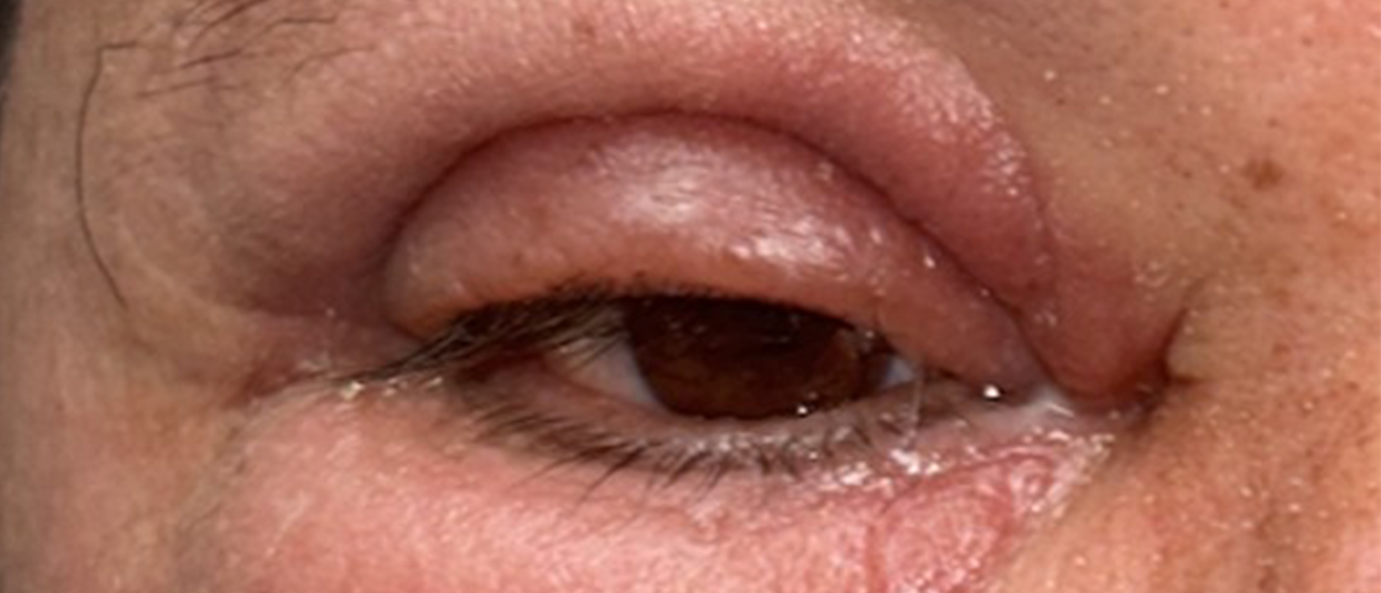 Periorbital Necrotizing Fasciitis