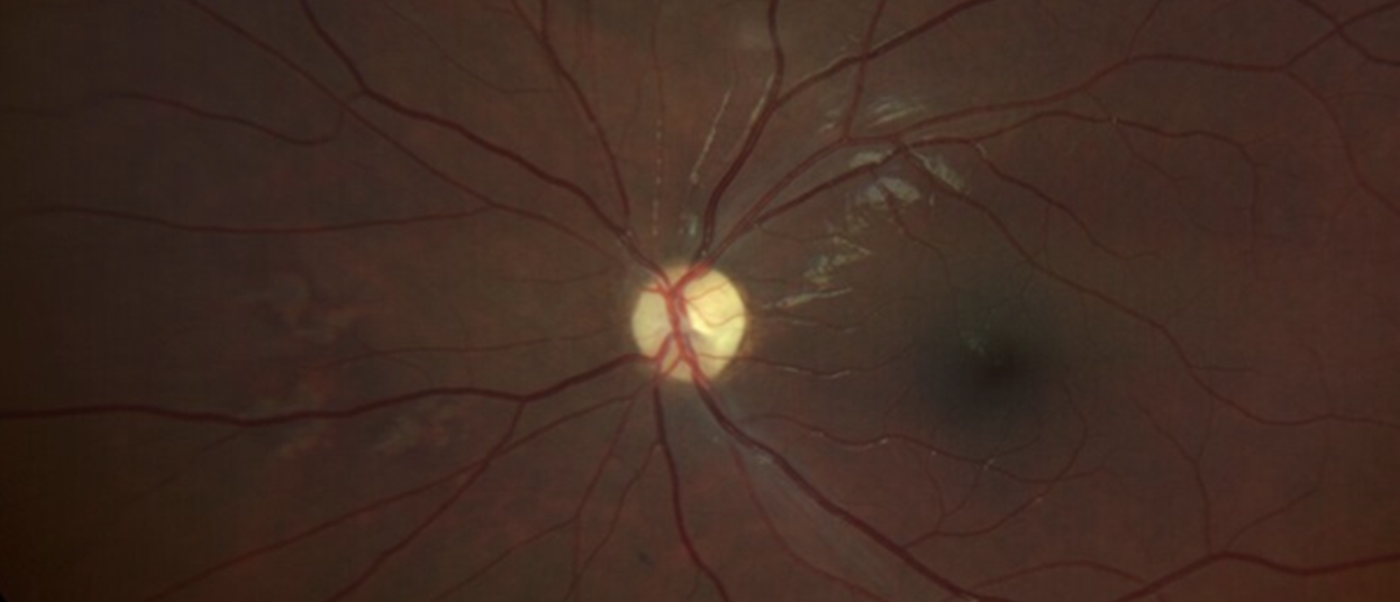 Radiation Optic Neuropathy