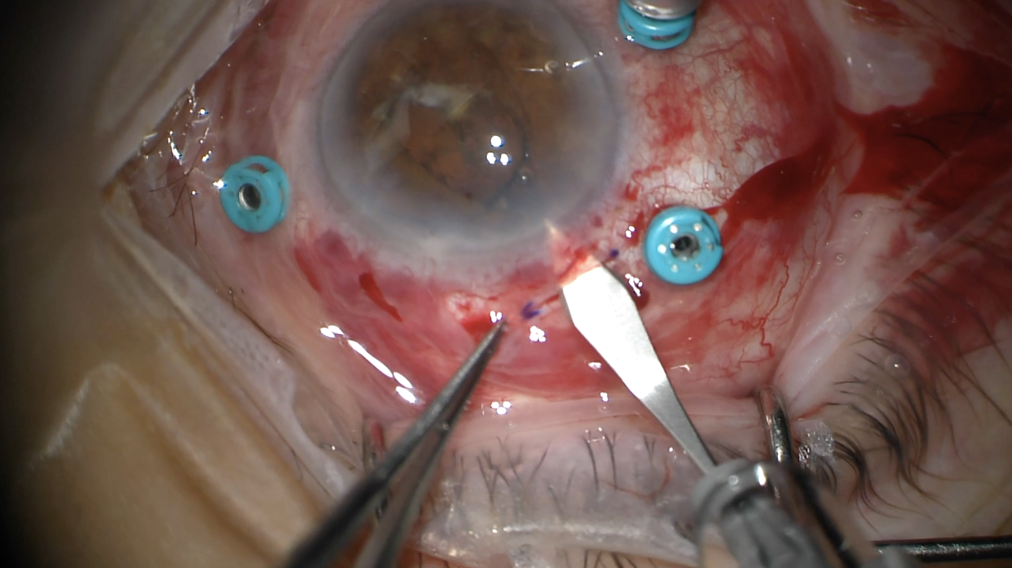 Fusariam Vetinarium Endophthalmitis Vitrectomy with Intraocular Lens Removal
