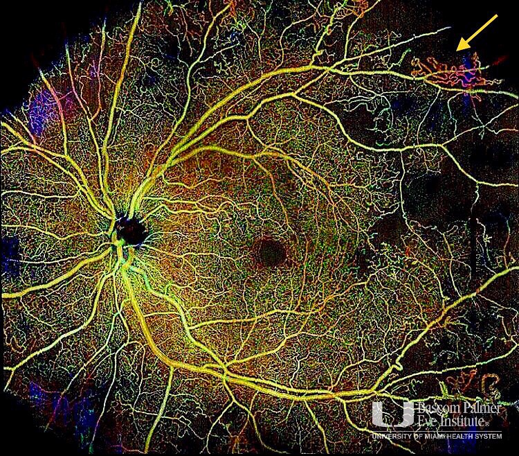 OCTA demonstrating neovascularization (yellow arrow) growing into the vitreous with widefield imaging.