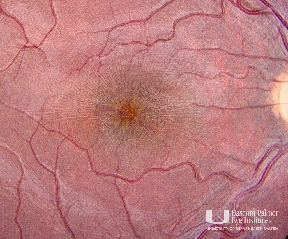 X-linked Retinoschisis