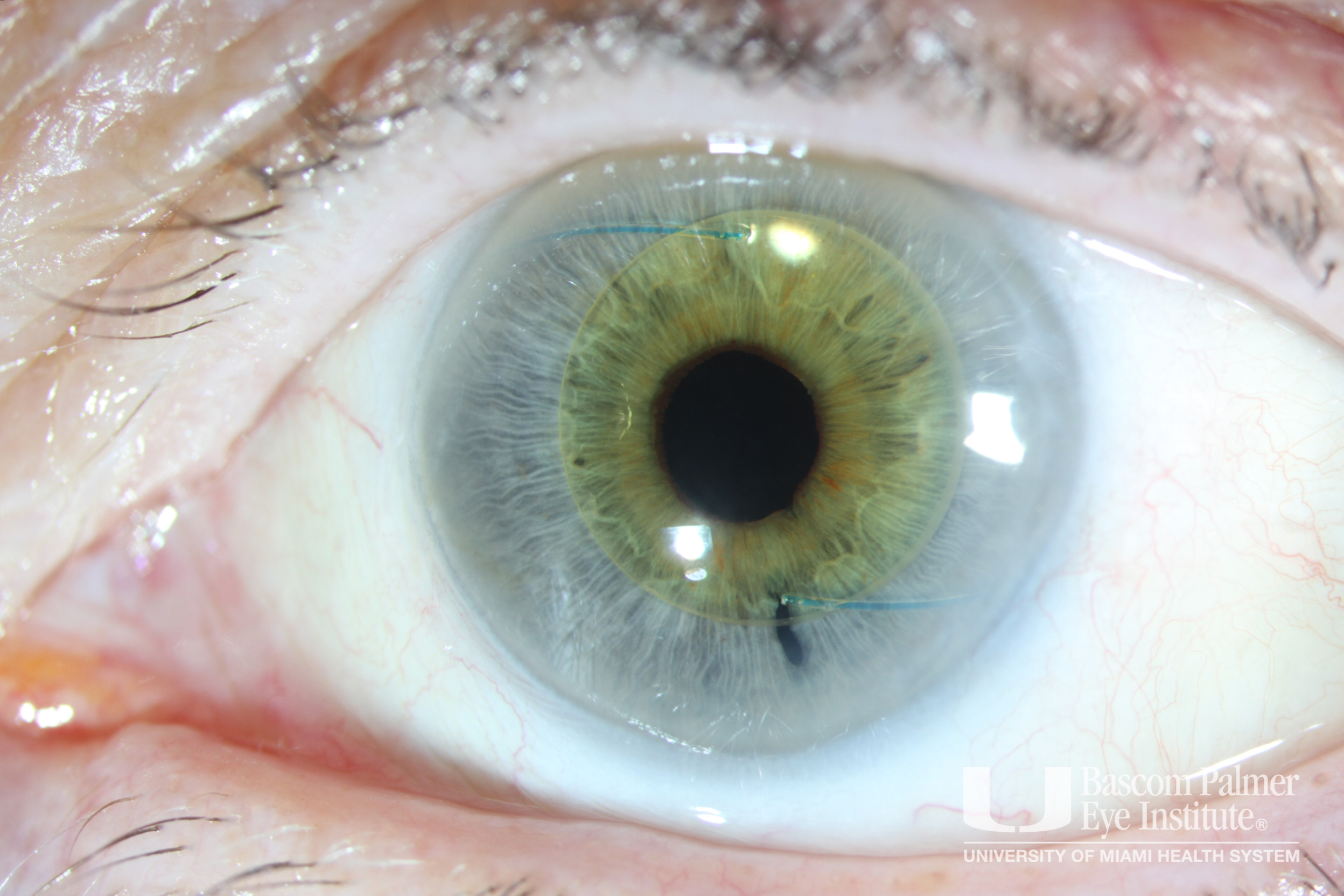 3-Piece Intraocular Lens in the Anterior Chamber