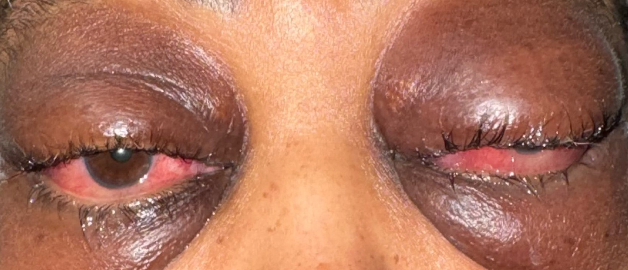 Idiopathic Orbital Inflammation 