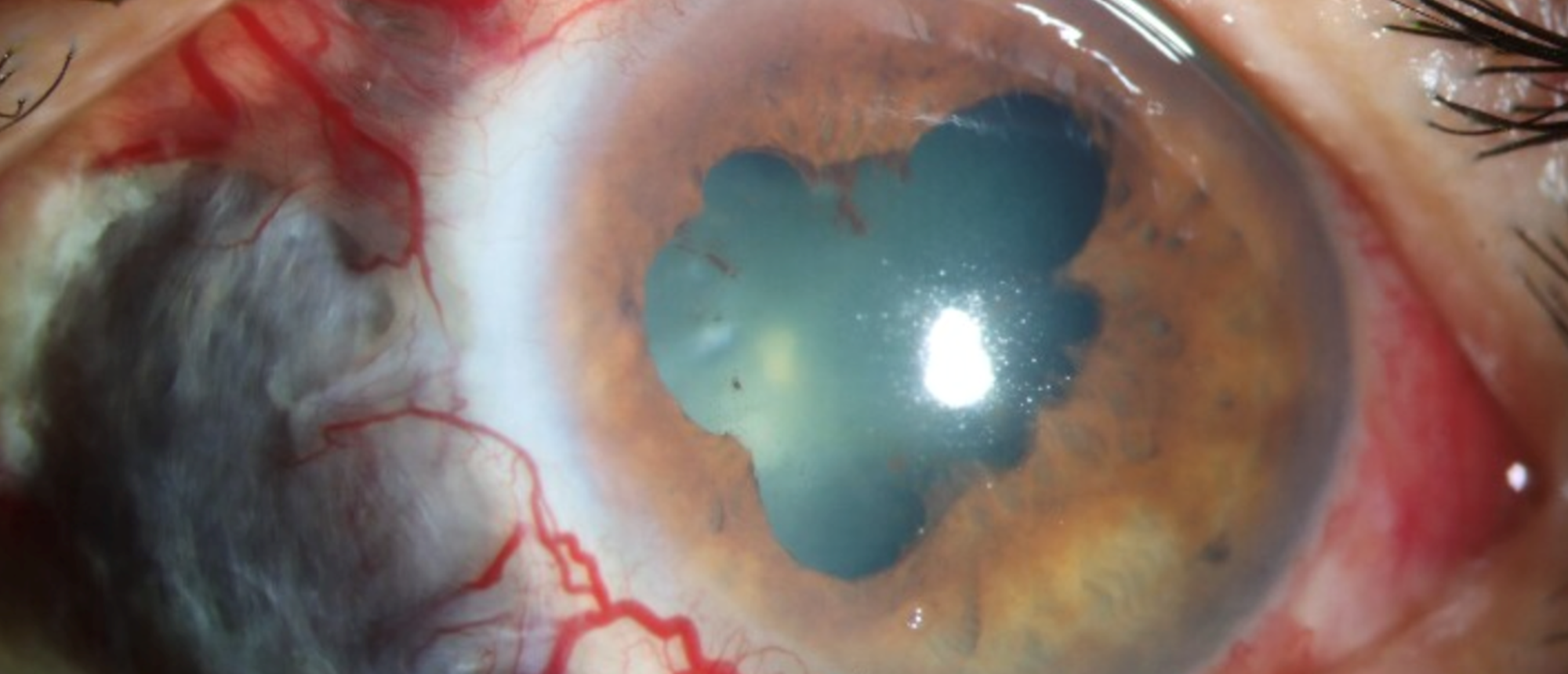 Infectious Necrotising Scleritis 