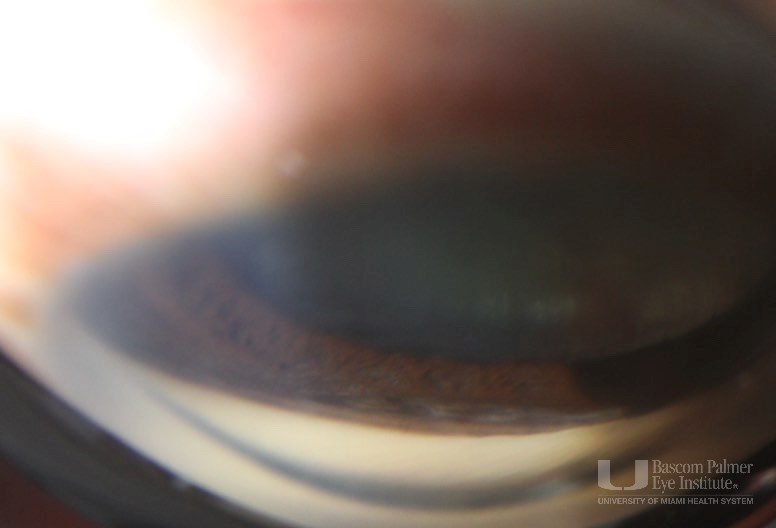 Cyclodialysis Cleft with Hypotony Maculopathy