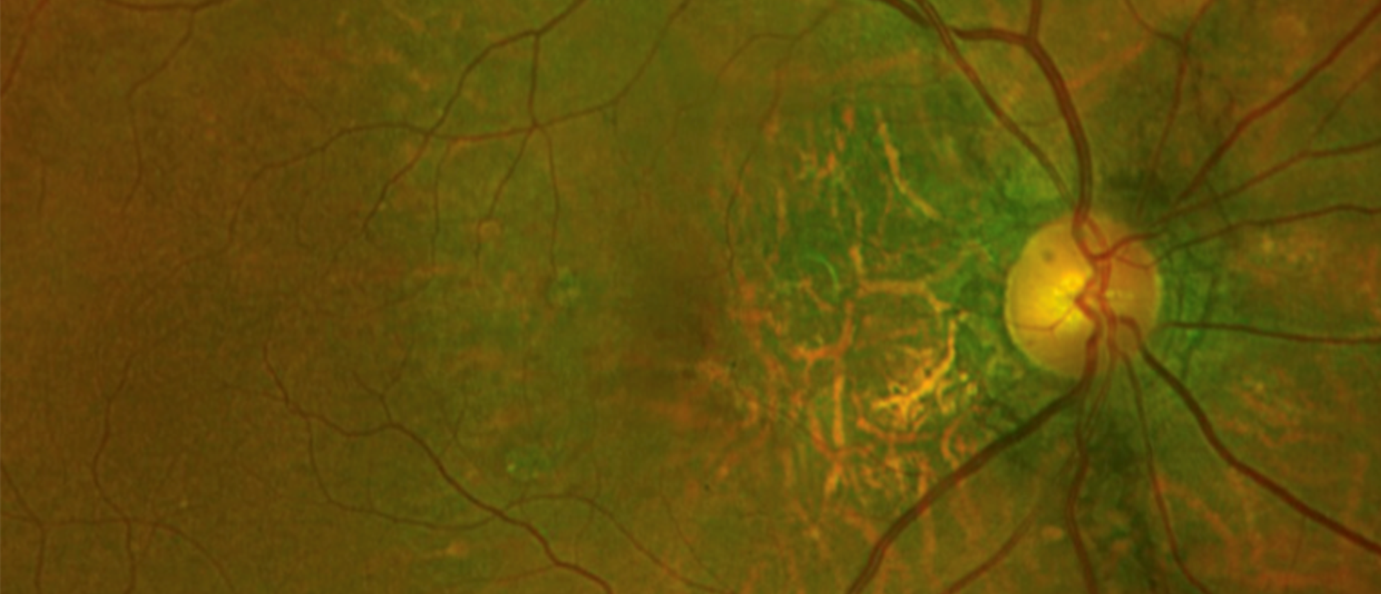 Pseudoxanthoma Elasticum 