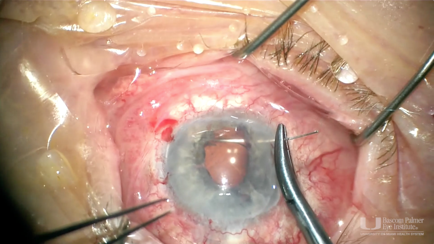 Single-Pass Four-Throw Pupilloplasty