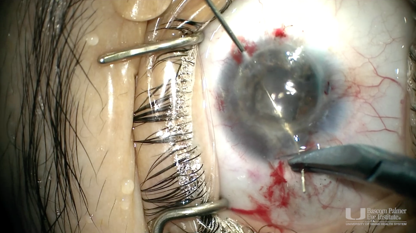 Single-Pass Four-Throw Pupilloplasty