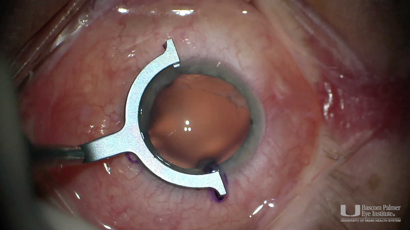 27 Gauge Modified Yamane 3 Port Sutureless IOL Scleral Fixation