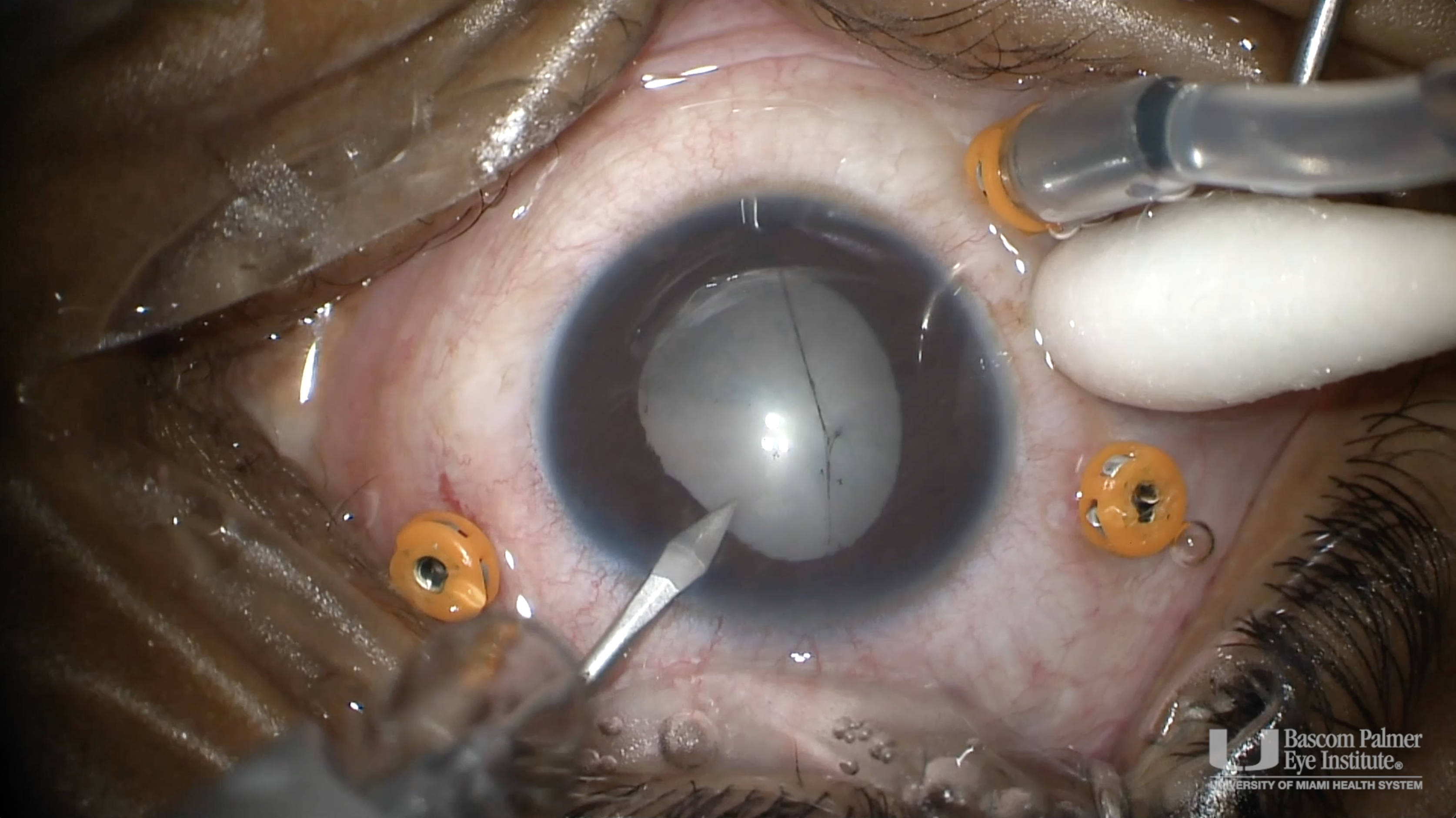 Phaco-Vitrectomy for Traumatic Cataract and Macular Hole with CTR