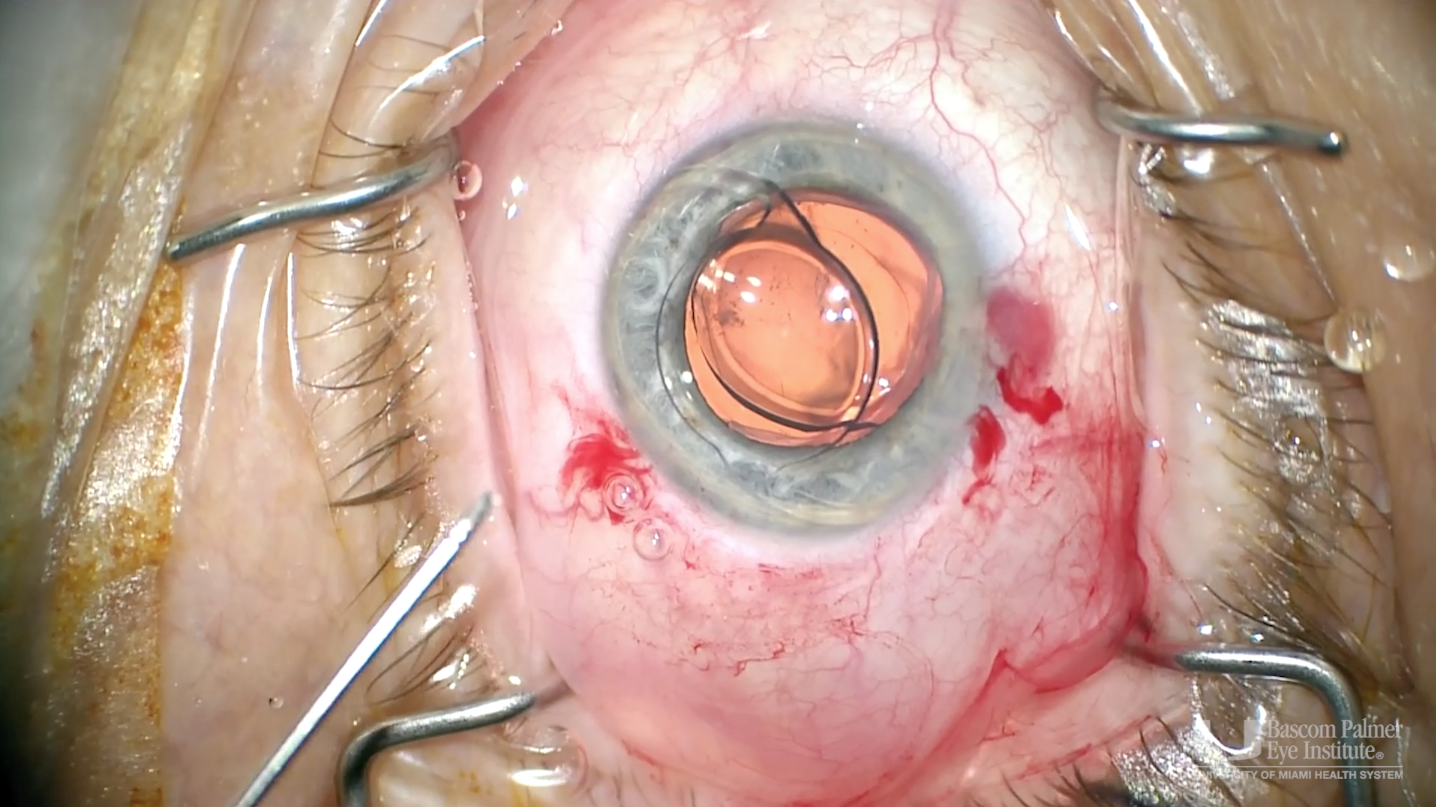 Intraocular Lens Exchange