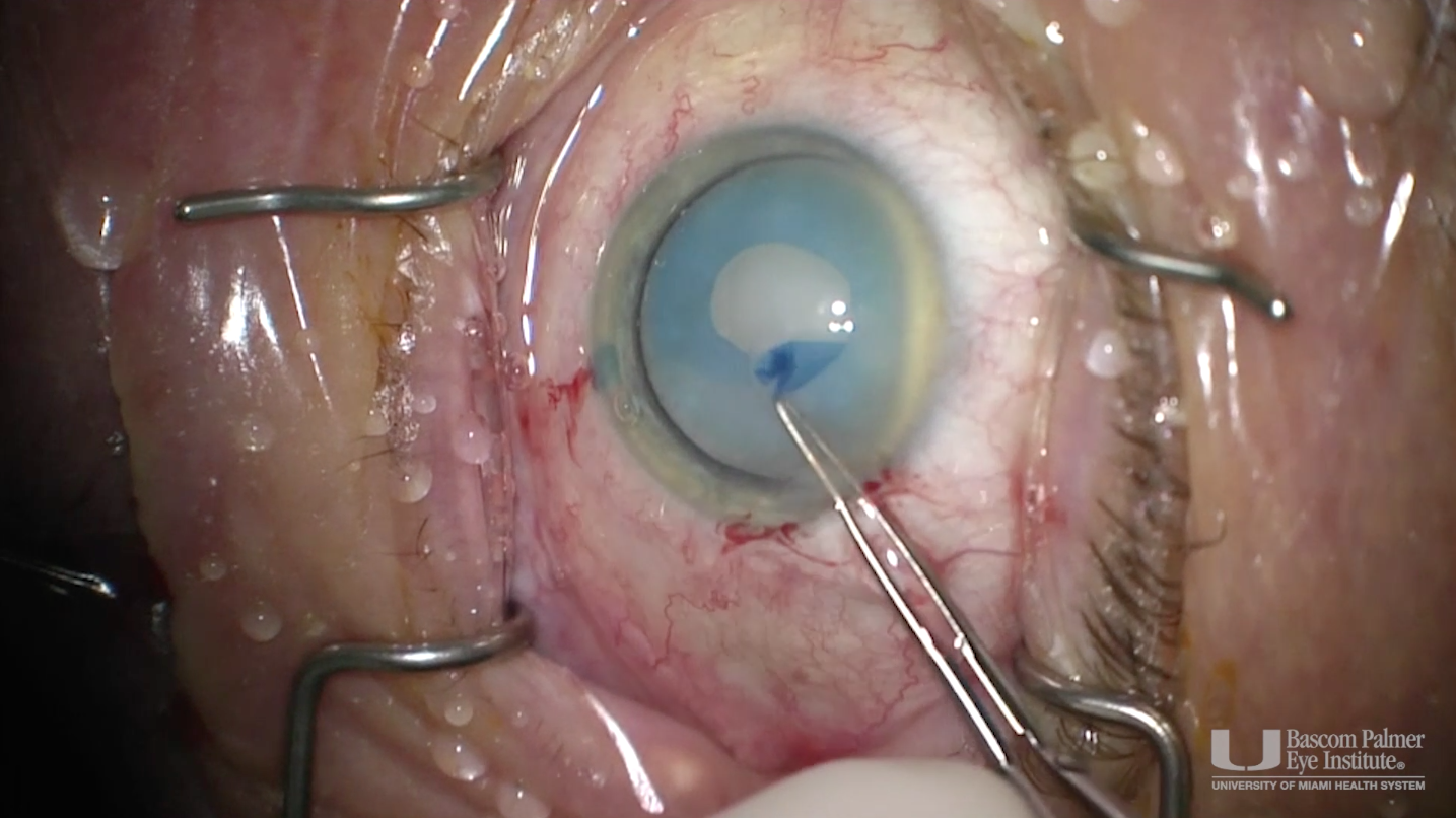 Morgagnian (Hypermature) Cataract