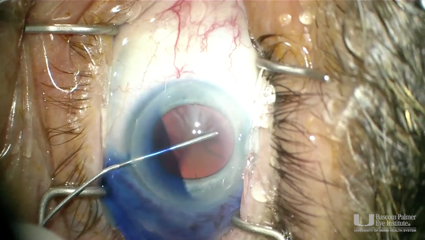 Use of a miLoop® Device in Dense Nucleus