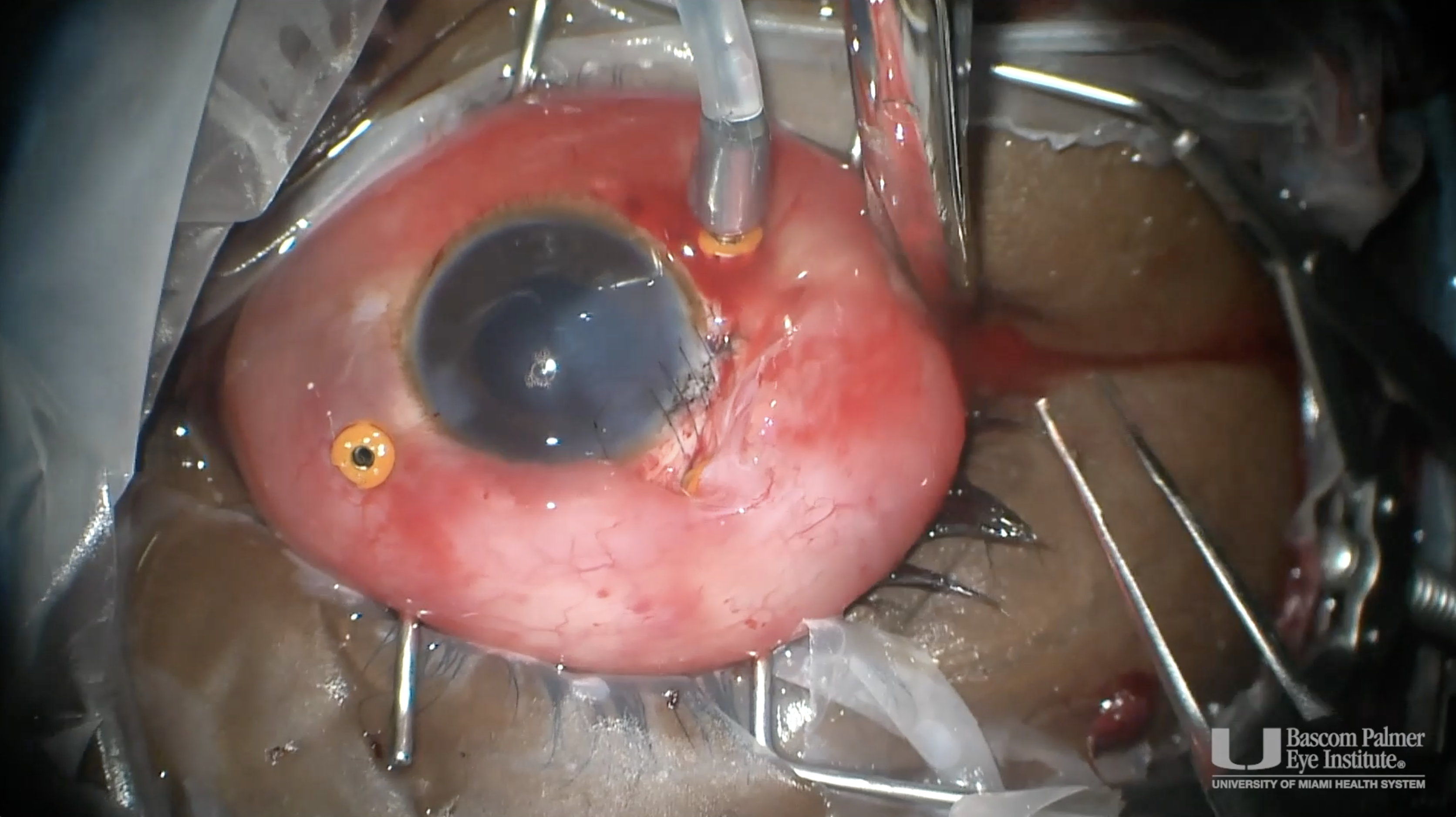 Ruptured Globe Repair with Orbital Compartment Syndrome and Disappearing PFO