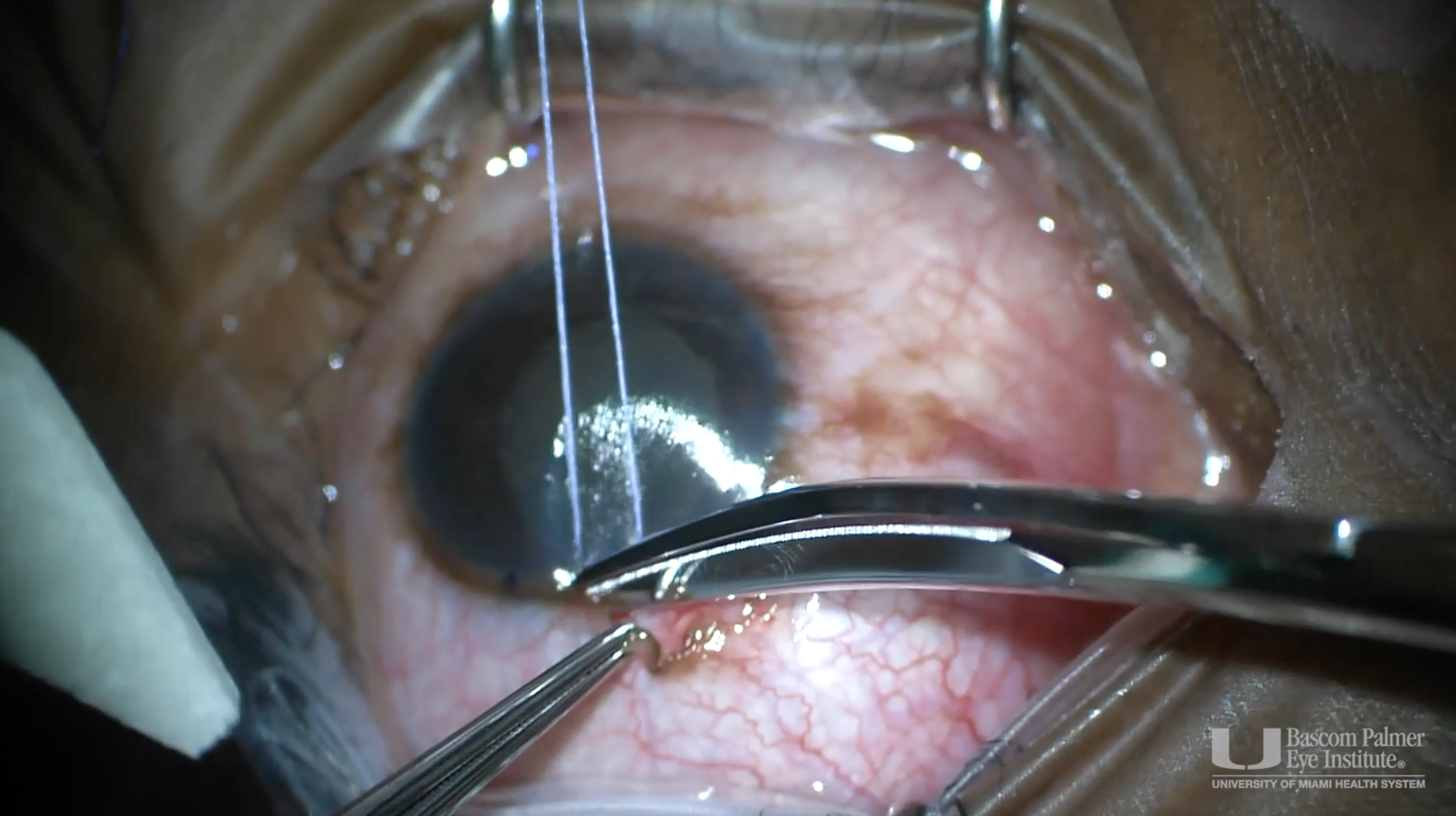 Repair of Cyclodialysis Cleft
