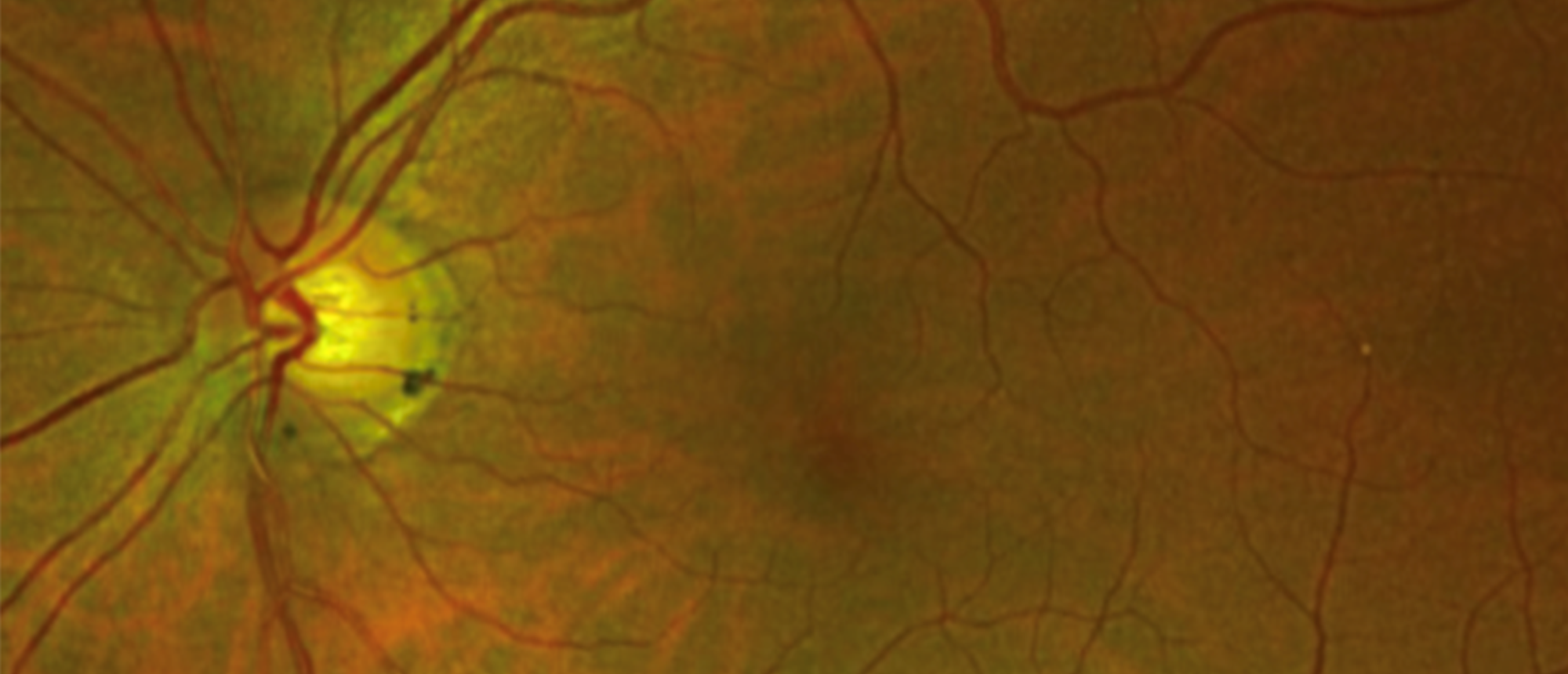 Neuromyelitis Optica Spectrum Disorder