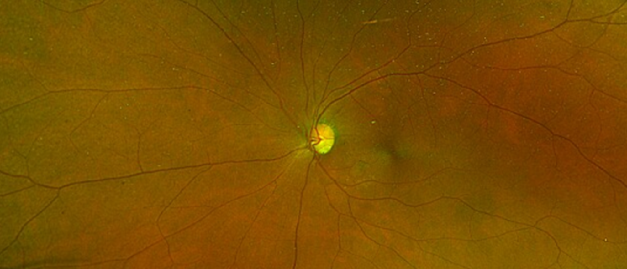  Neurosarcoidosis 