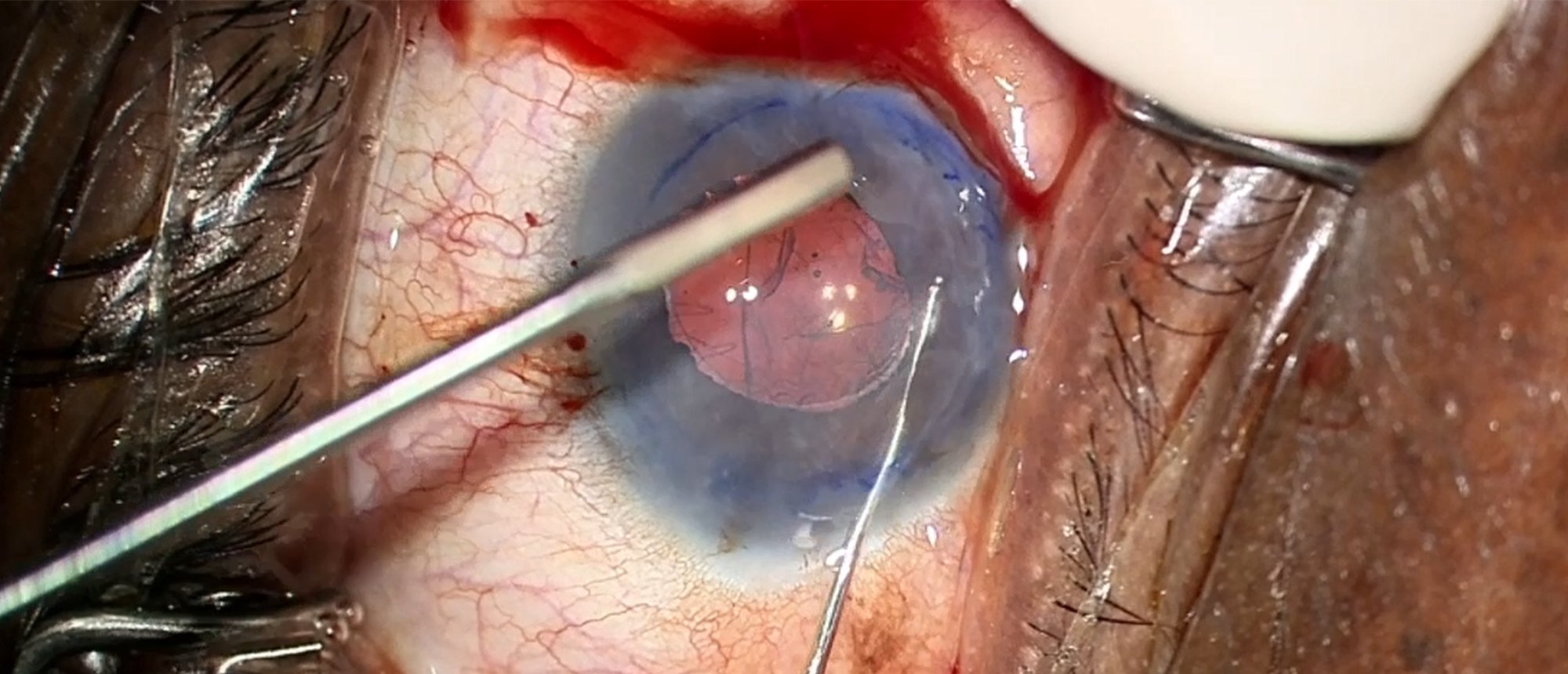 Syphilitic Interstitial Keratitis