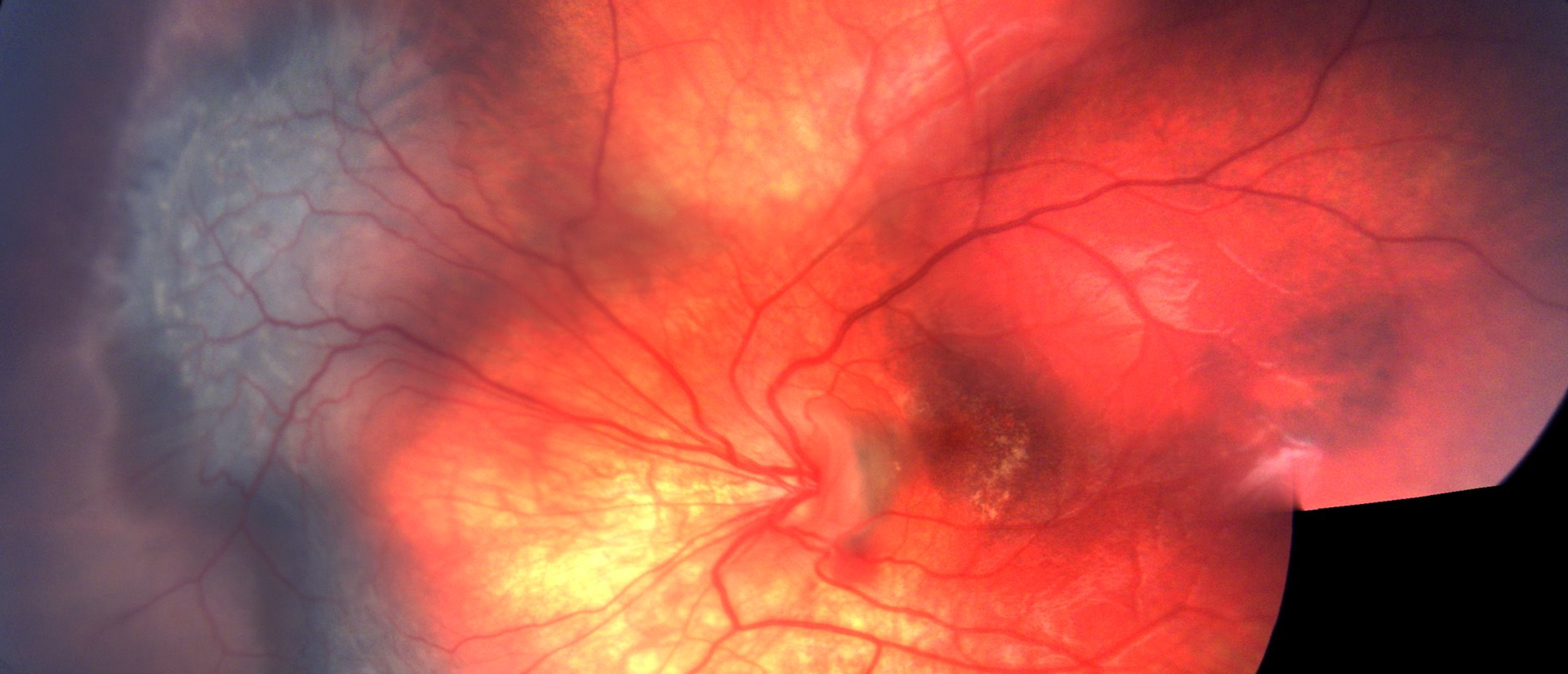 Combined Hamartoma of the Retina and Retinal Pigment Epithelium