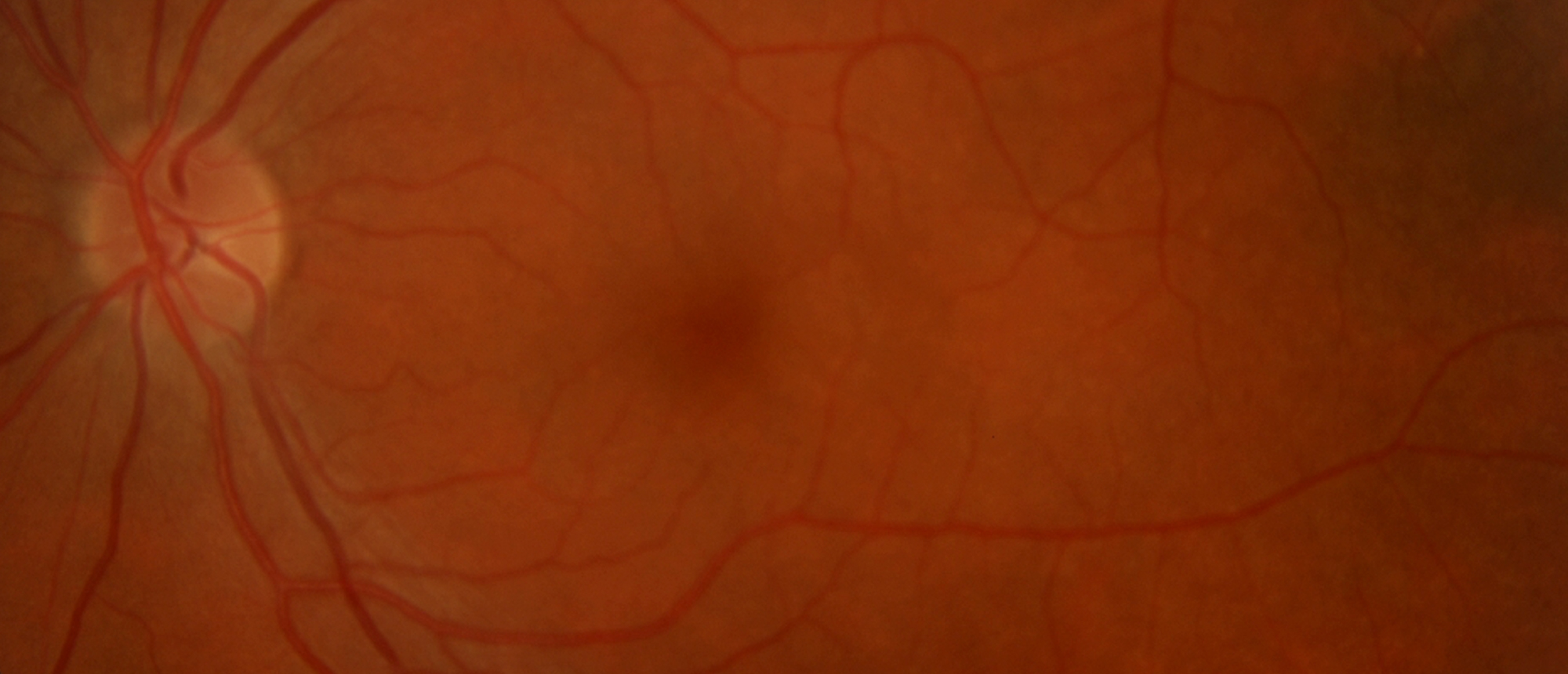 Intracanalicular Optic Nerve Sheath Meningioma