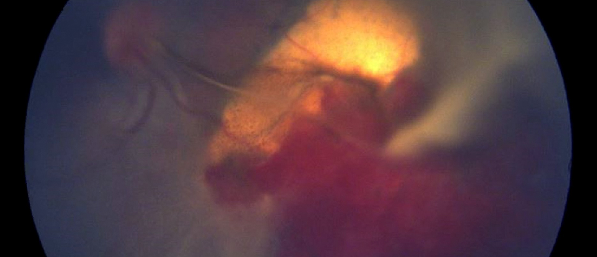 Retinal Cavernous Hemangioma with Vitreous Hemorrhage