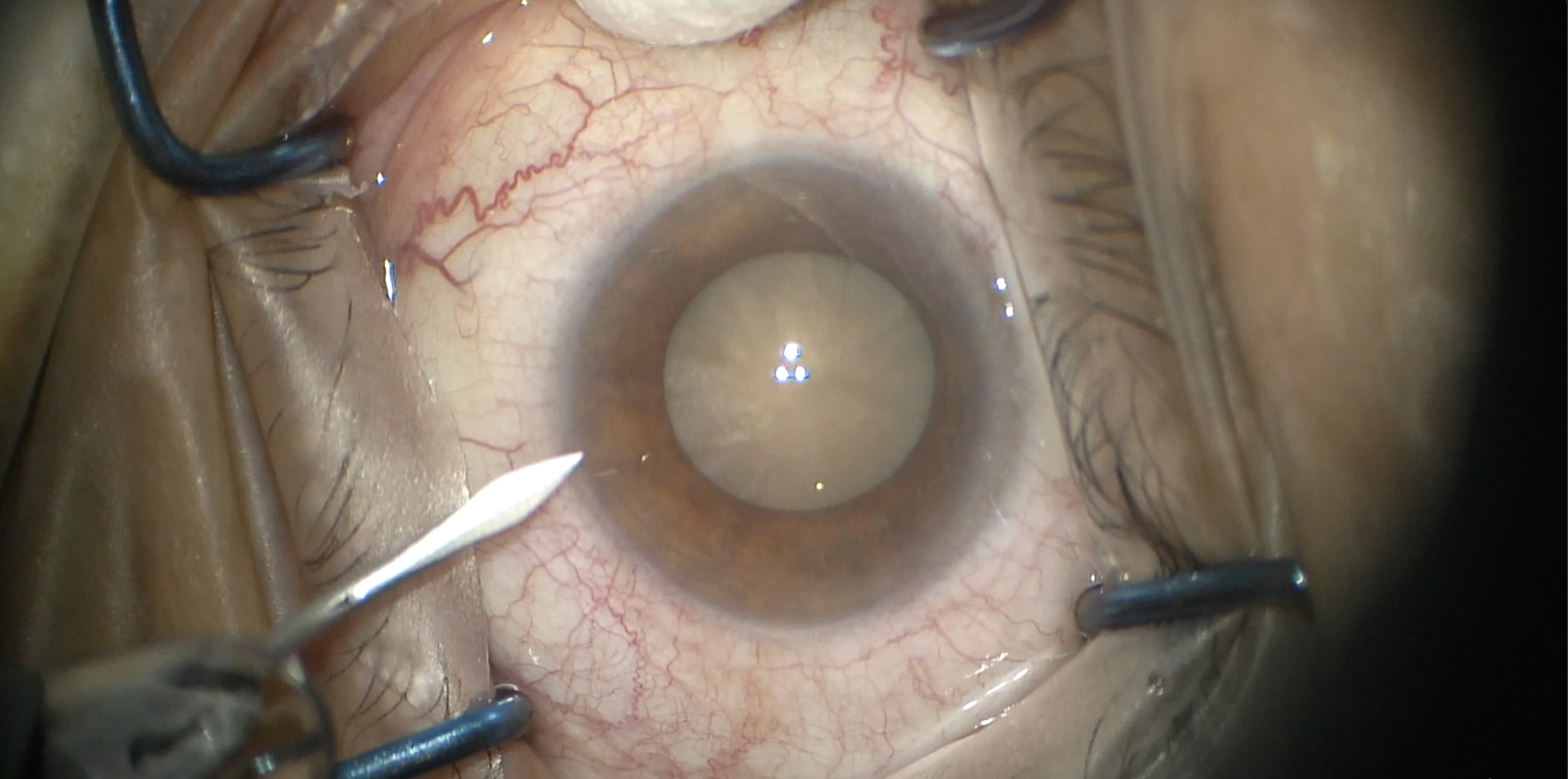 Dense Cataract with miLOOP