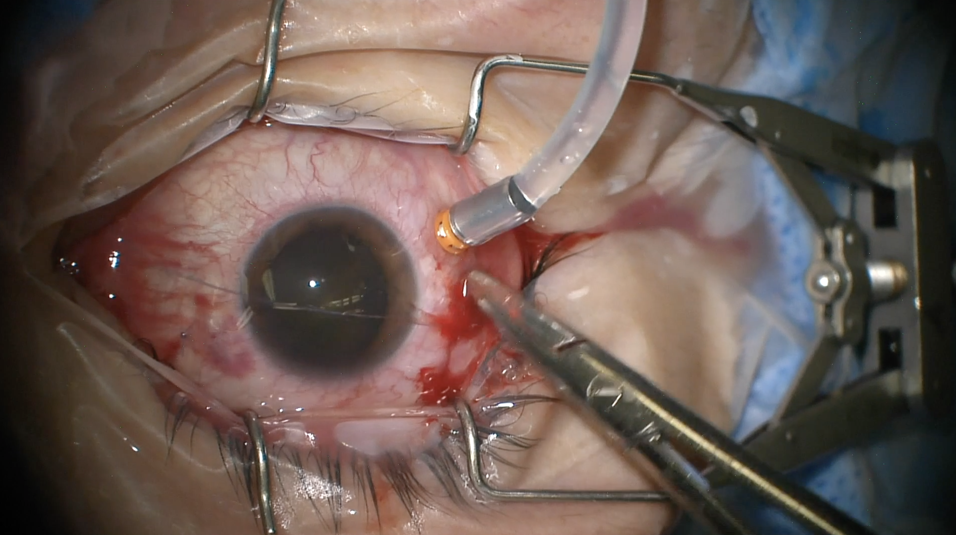 Removal of Live Intraocular Parasite with Vitrectomy