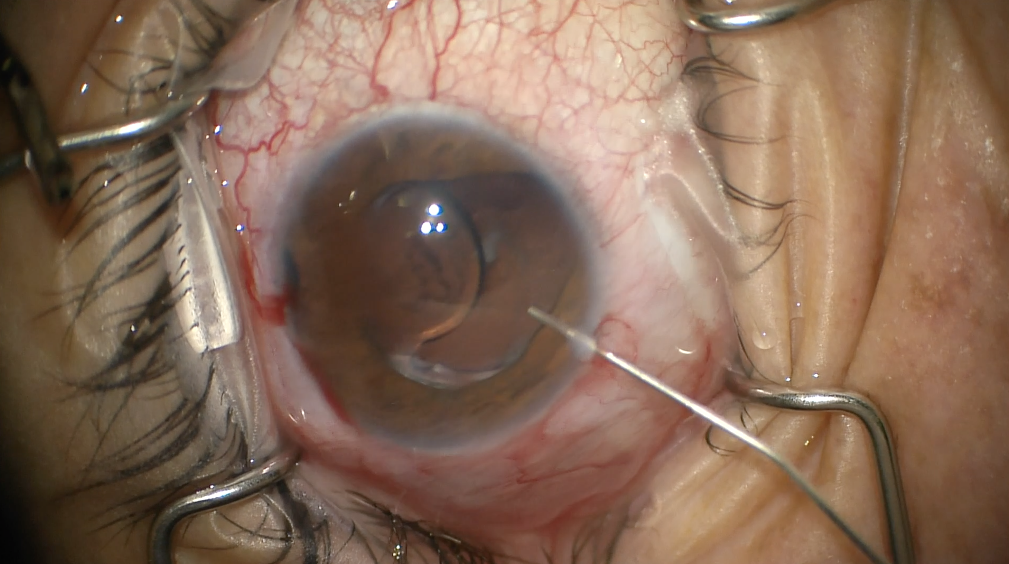 IOL Exchange + SFT Pupilloplasty