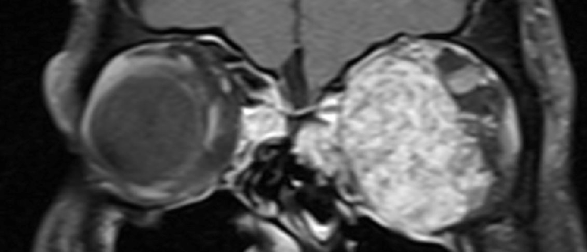 Orbital Venous Lymphatic Malformation
