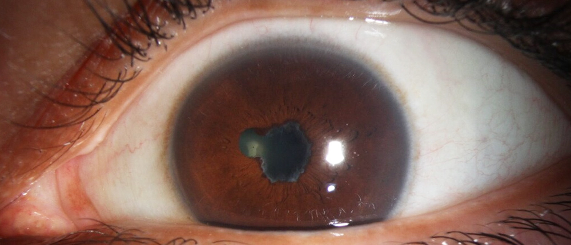 Tattoo Granuloma with Uveitis