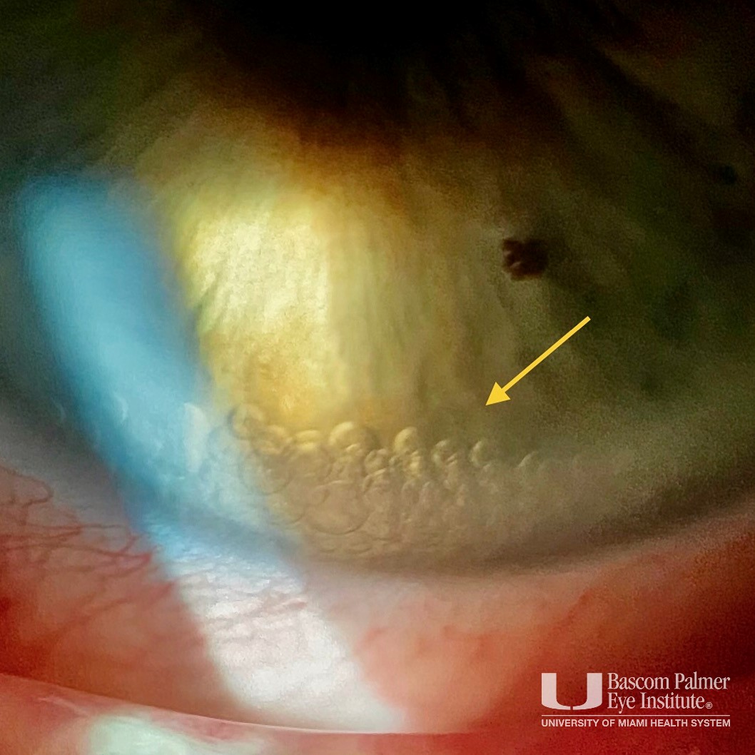 PFO liquid in the anterior chamber after retinal surgery. This caused some corneal edema and required removal.