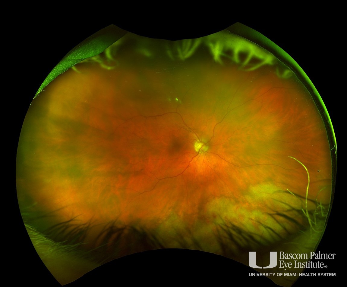 Retinal Whitening from Cytomegalovirus Infection