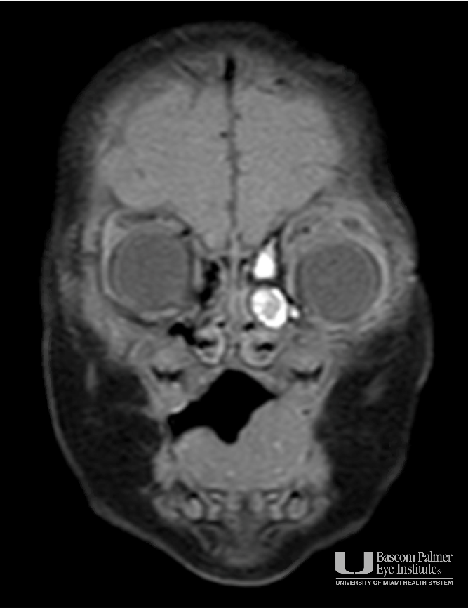 Alveolar Rhabdomyosarcoma