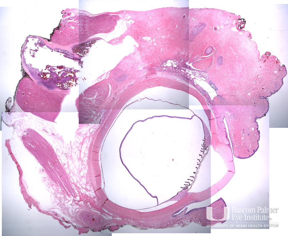 Alveolar Rhabdomyosarcoma