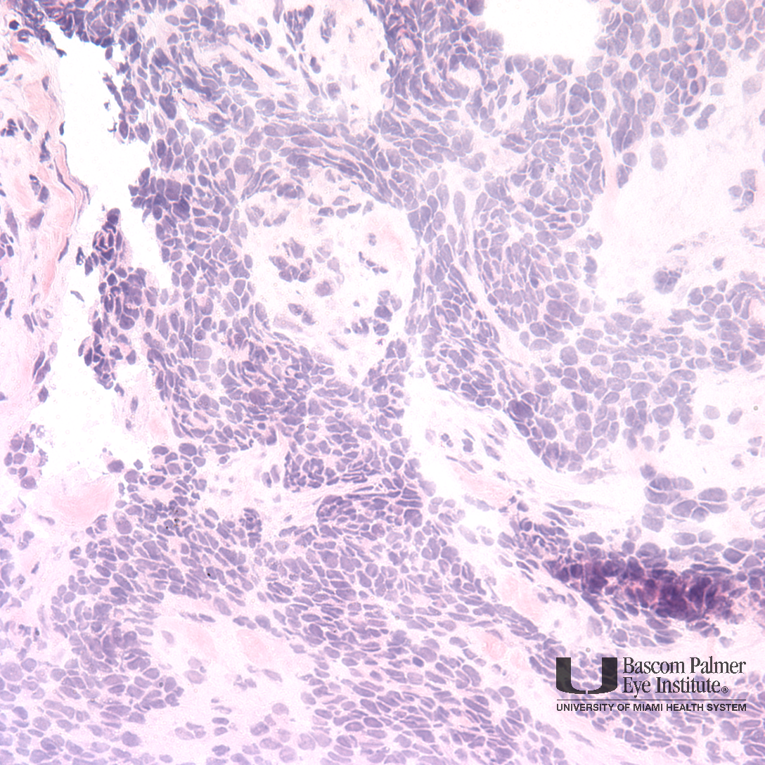 Alveolar Rhabdomyosarcoma
