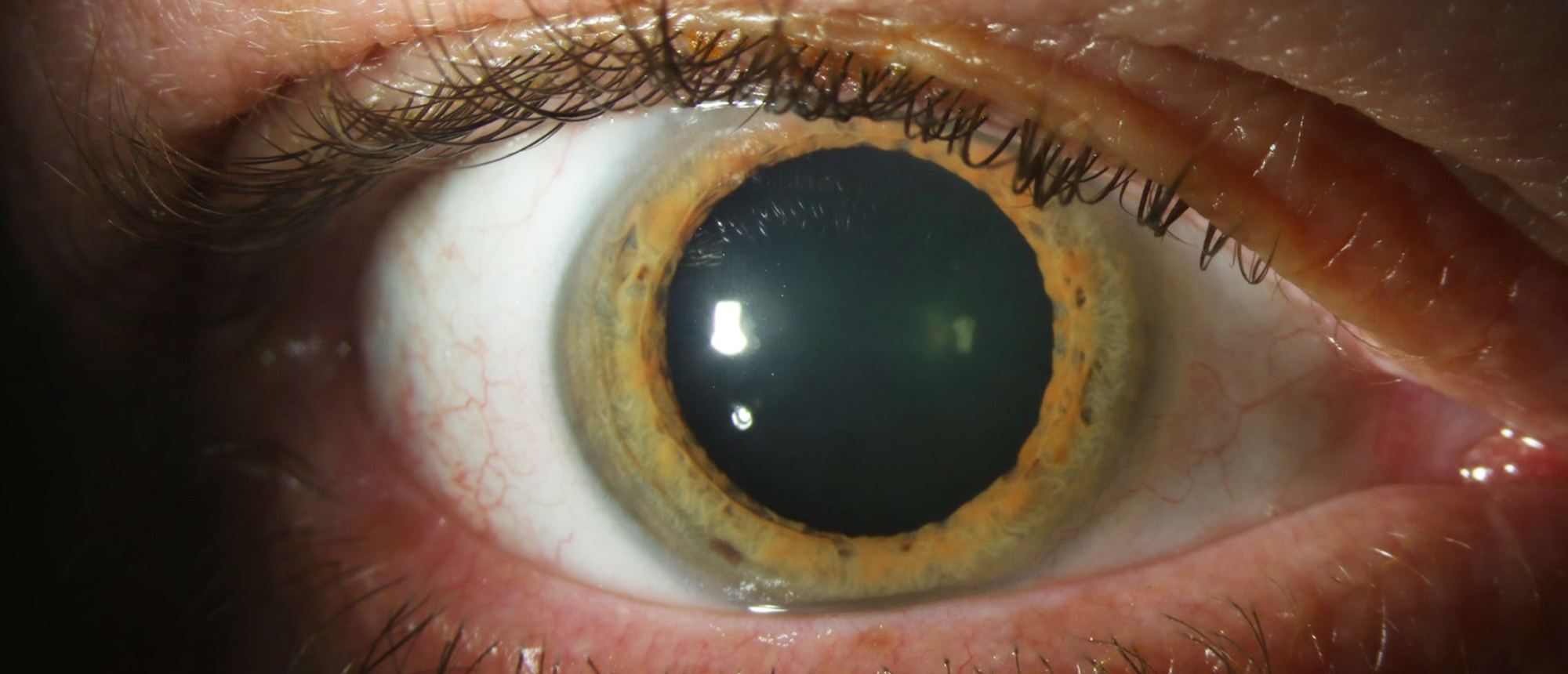 Conjunctival Amyloidosis