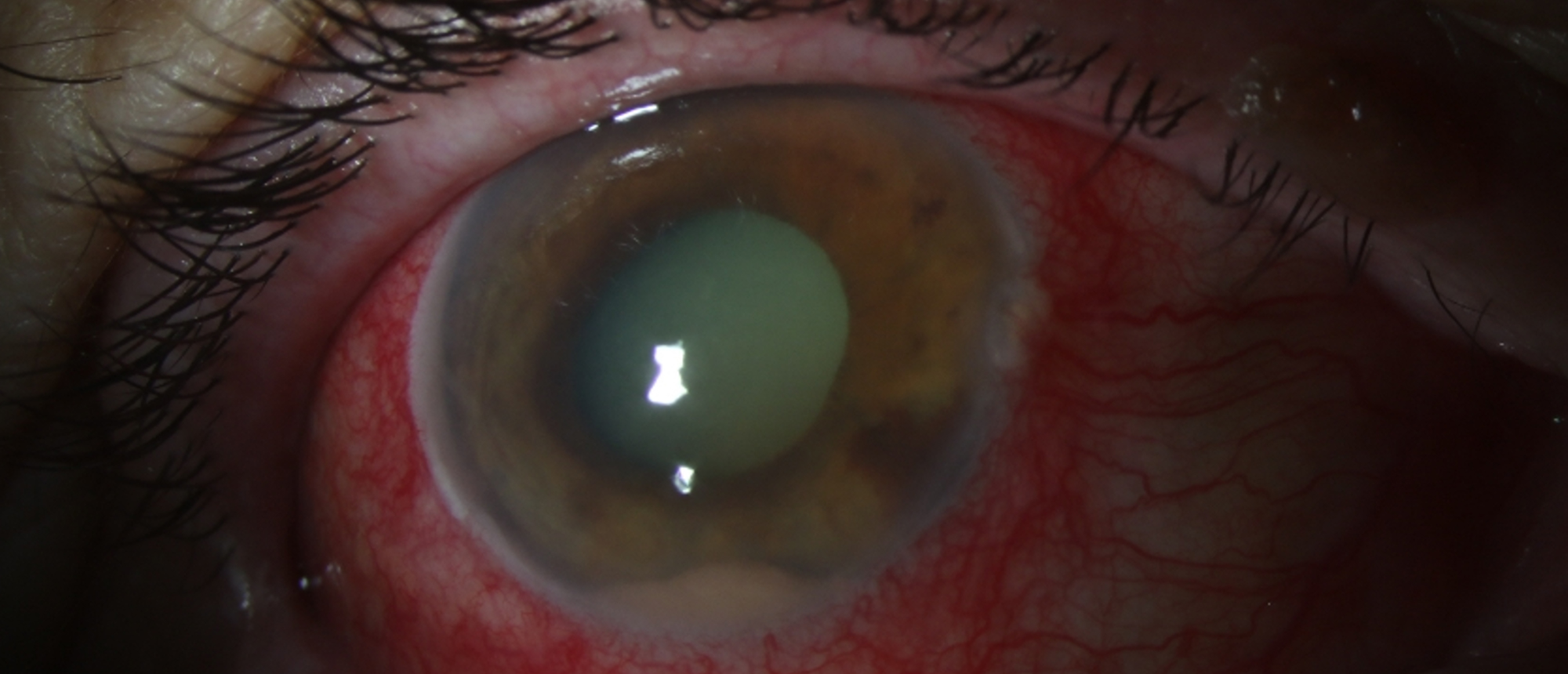 Phacolytic Glaucoma