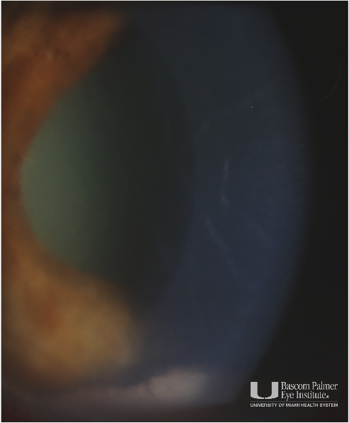 Phacolytic Glaucoma 