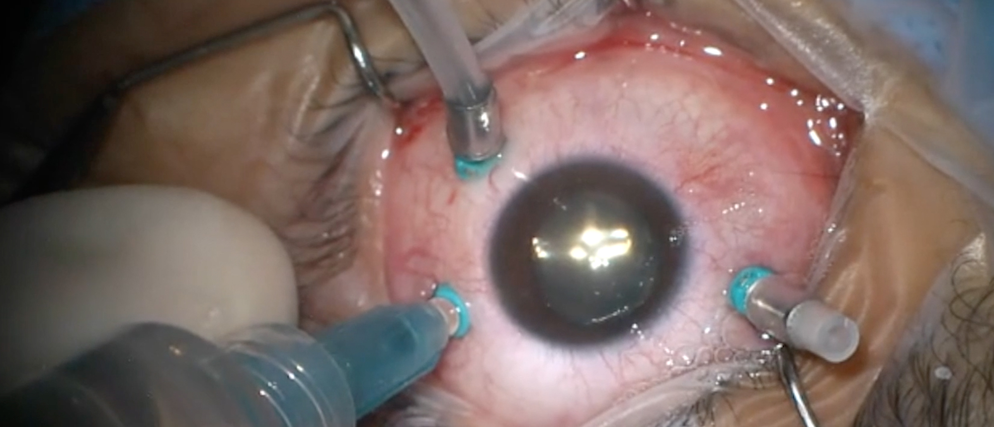 Toxoplasmosis Biopsy