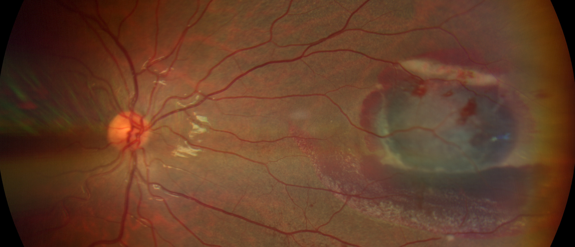 Intraorbital Foreign Body