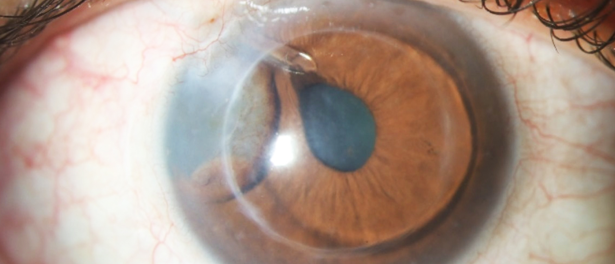 Epithelial Downgrowth