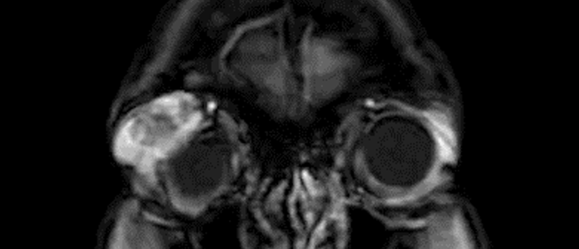 Adenoid Cystic Carcinoma