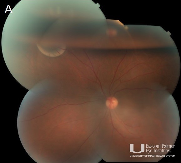 Fundus photo montage showing superonasal sub-retinal gas in the left eye on POD 1 after pneumatic retinopexy. 