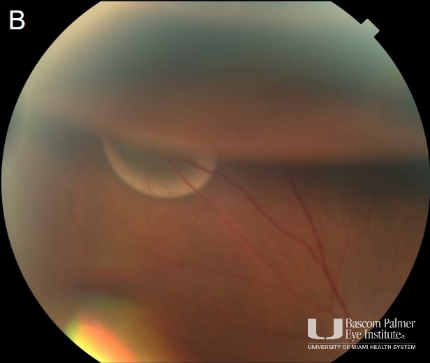 Single frame fundus photo showing the same. 