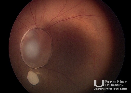Optic Nerve Cyst and Coloboma