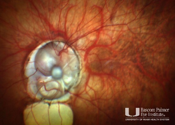 Optic nerve coloboma