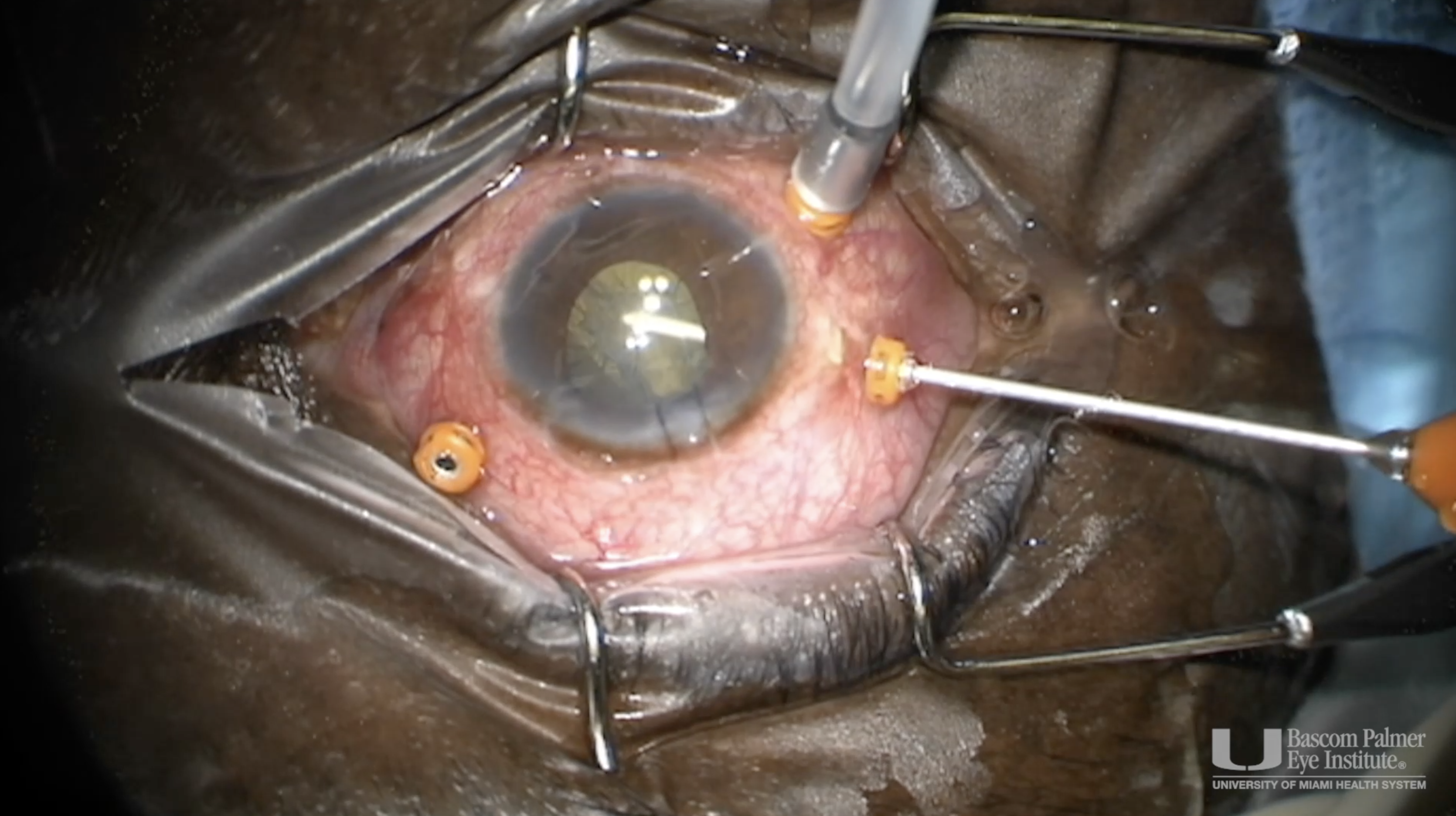 Sub-Retina Band Removal in PVR Detachment